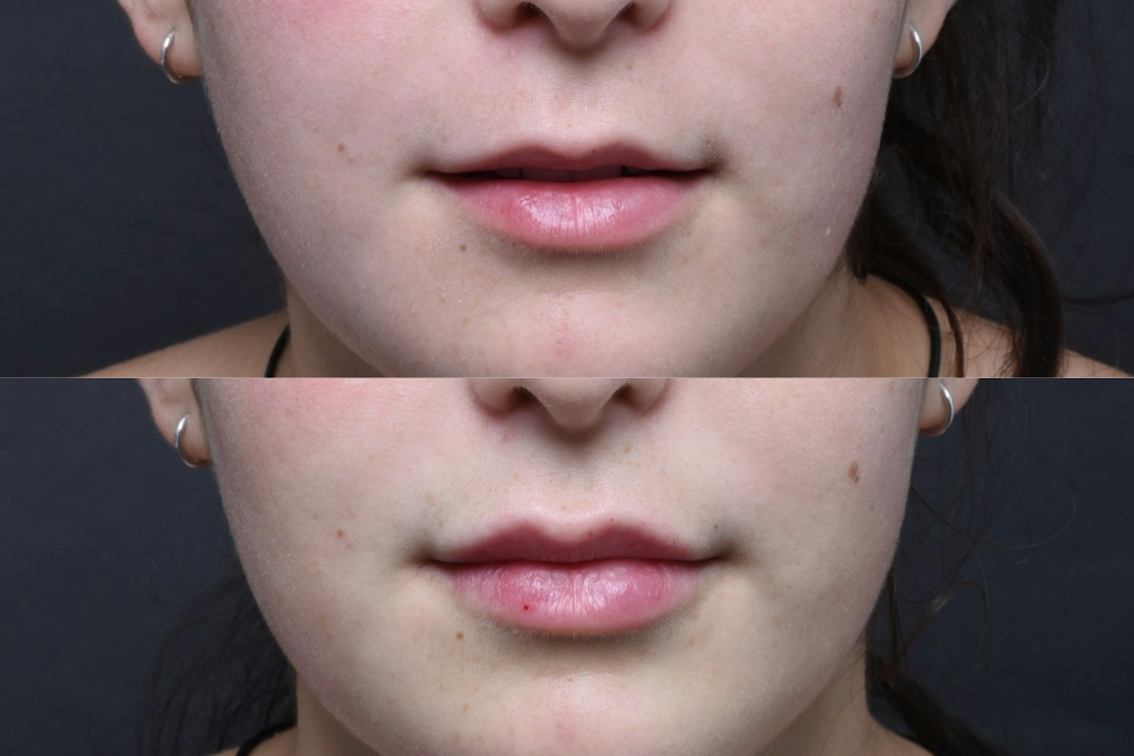 Austin Injectable Fillers Before & After Gallery - Patient 712627 - Image 1 - The Piazza Center
