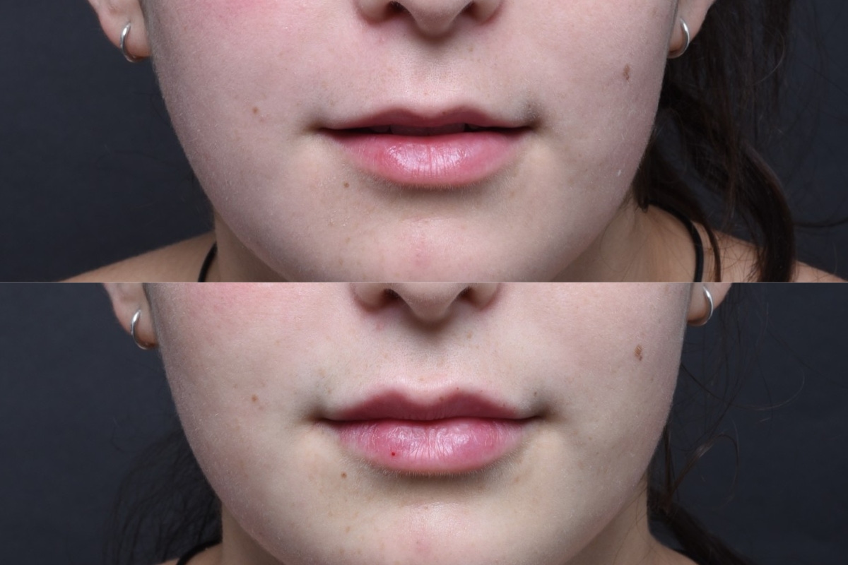 Austin Injectable Fillers Before & After Gallery - Patient 712627 - Image 1 - The Piazza Center