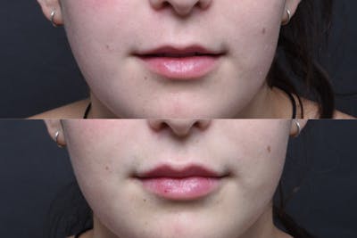 Austin Injectable Fillers Before & After Gallery - Patient 712627 - Image 1 - The Piazza Center