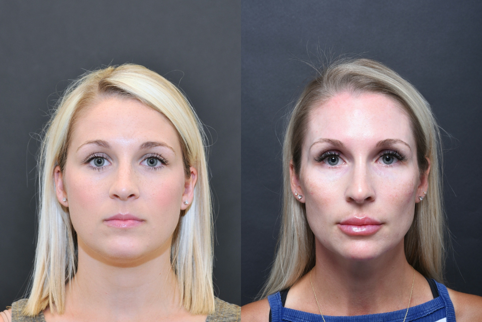 Austin Wrinkle Relaxers Before & After Gallery - Patient 269541 - Image 1 - The Piazza Center