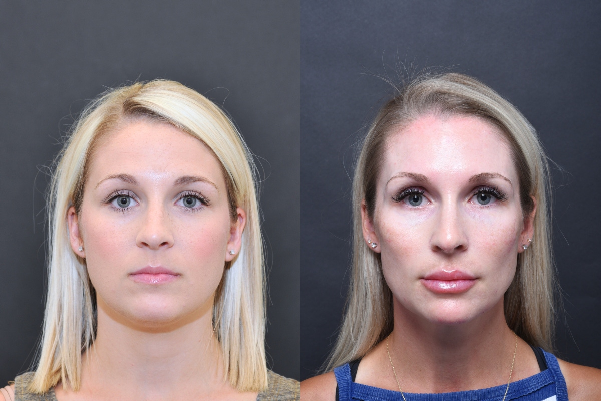 Austin Wrinkle Relaxers Before & After Gallery - Patient 269541 - Image 1 - The Piazza Center