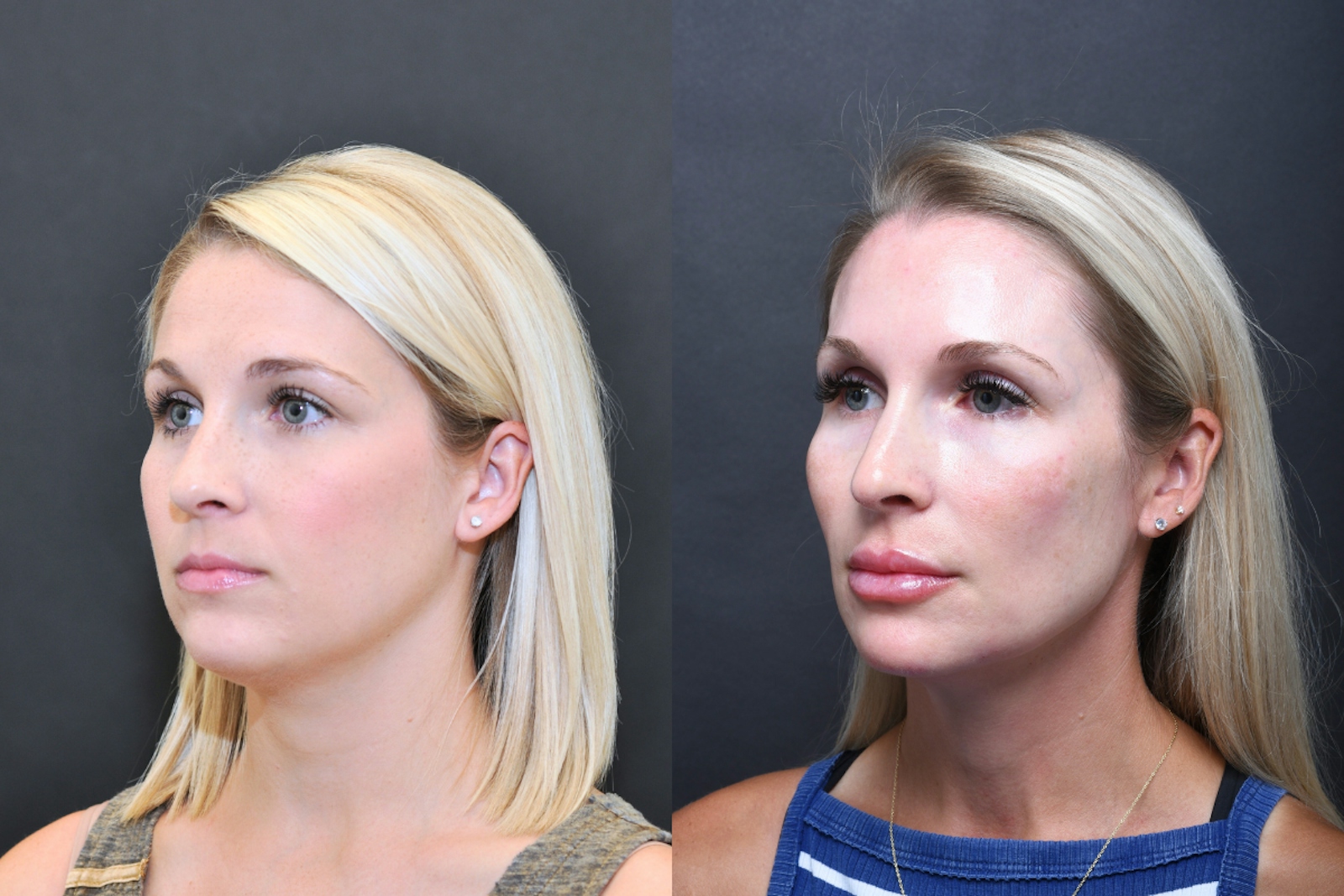Austin Wrinkle Relaxers Before & After Gallery - Patient 269541 - Image 2 - The Piazza Center