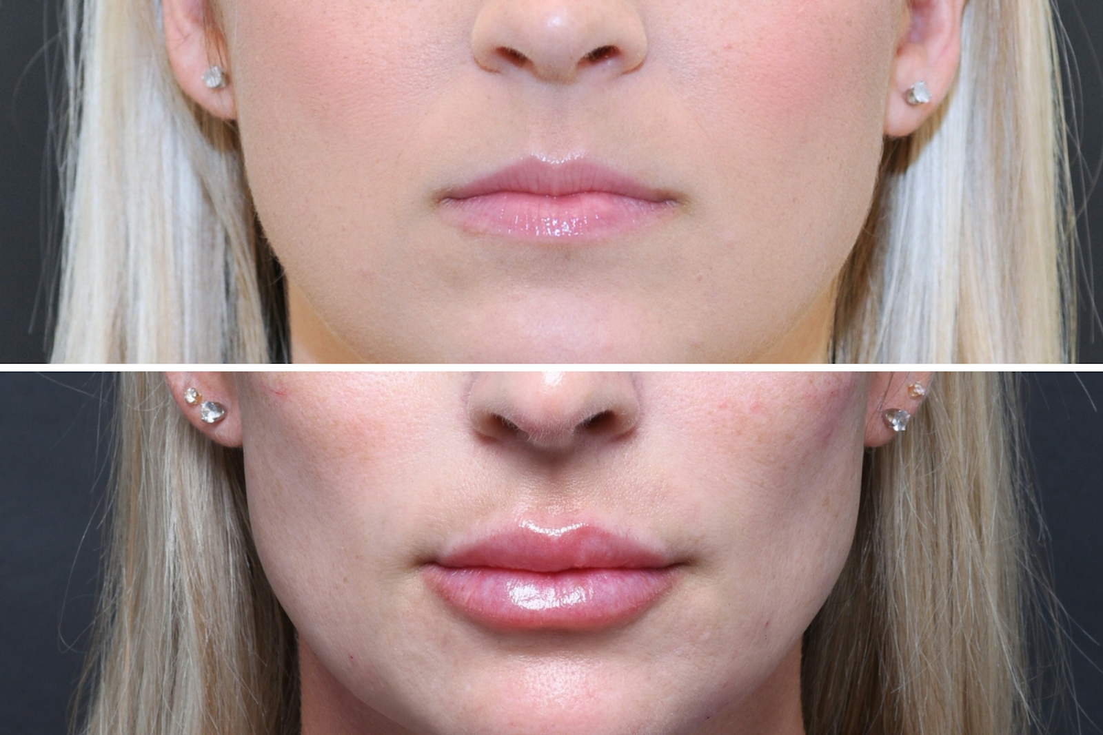 Austin Wrinkle Relaxers Before & After Gallery - Patient 269541 - Image 3 - The Piazza Center