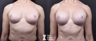 Austin Breast Augmentation Before & After Gallery - Patient 276383 - Image 1 - The Piazza Center