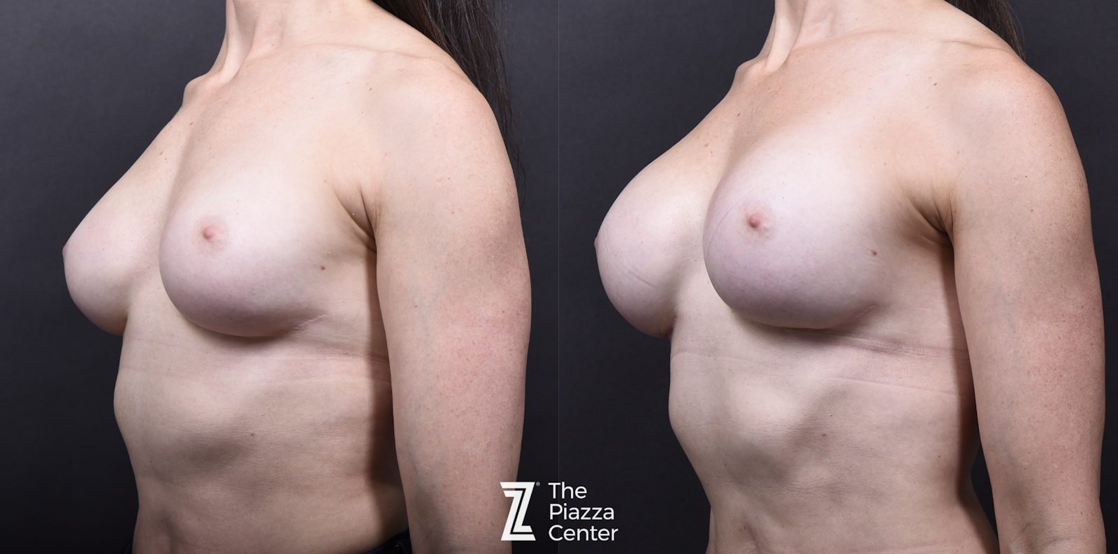 Austin Breast Augmentation Revision Before & After Gallery - Patient 252642 - Image 2 - The Piazza Center