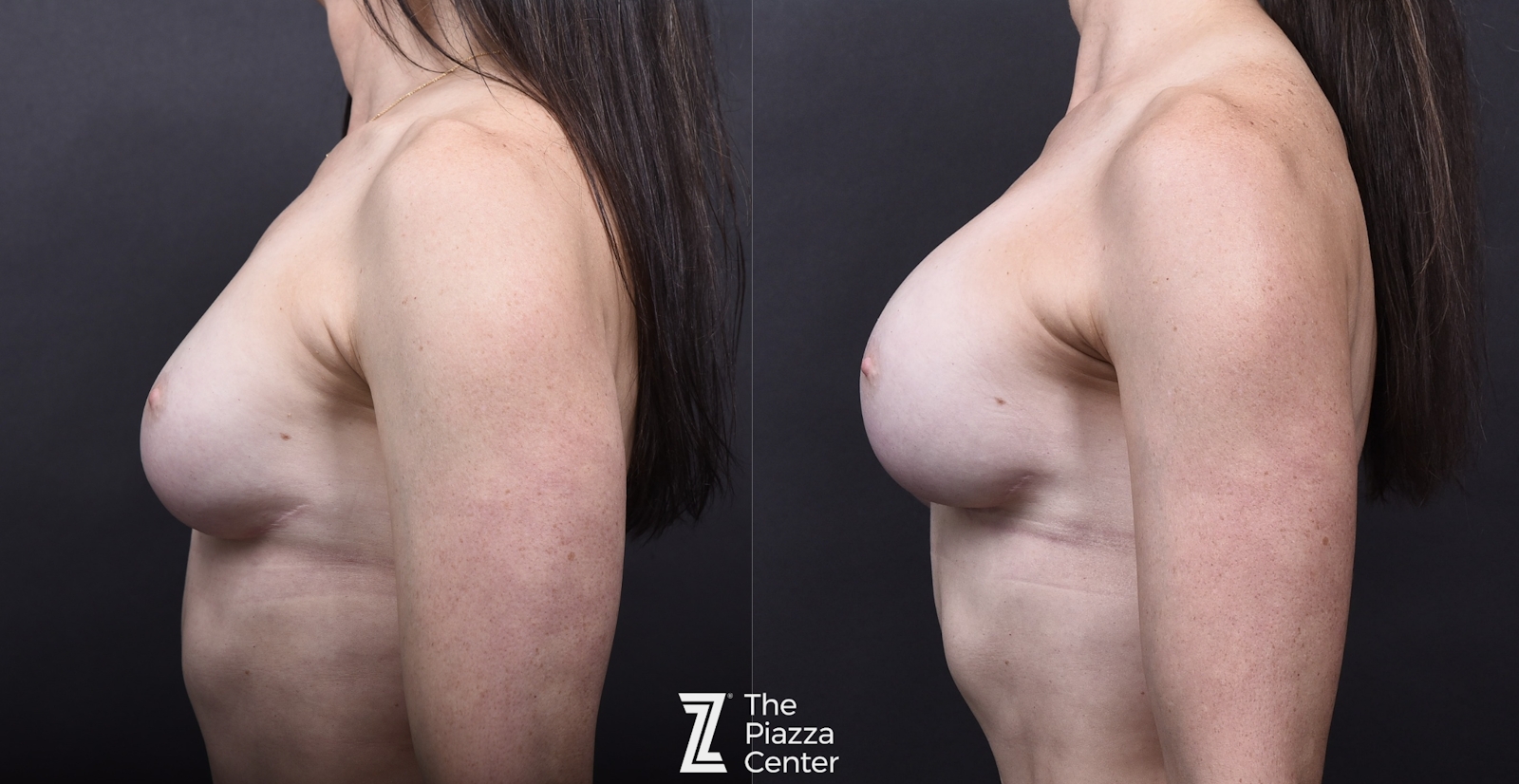 Austin Breast Augmentation Revision Before & After Gallery - Patient 252642 - Image 3 - The Piazza Center