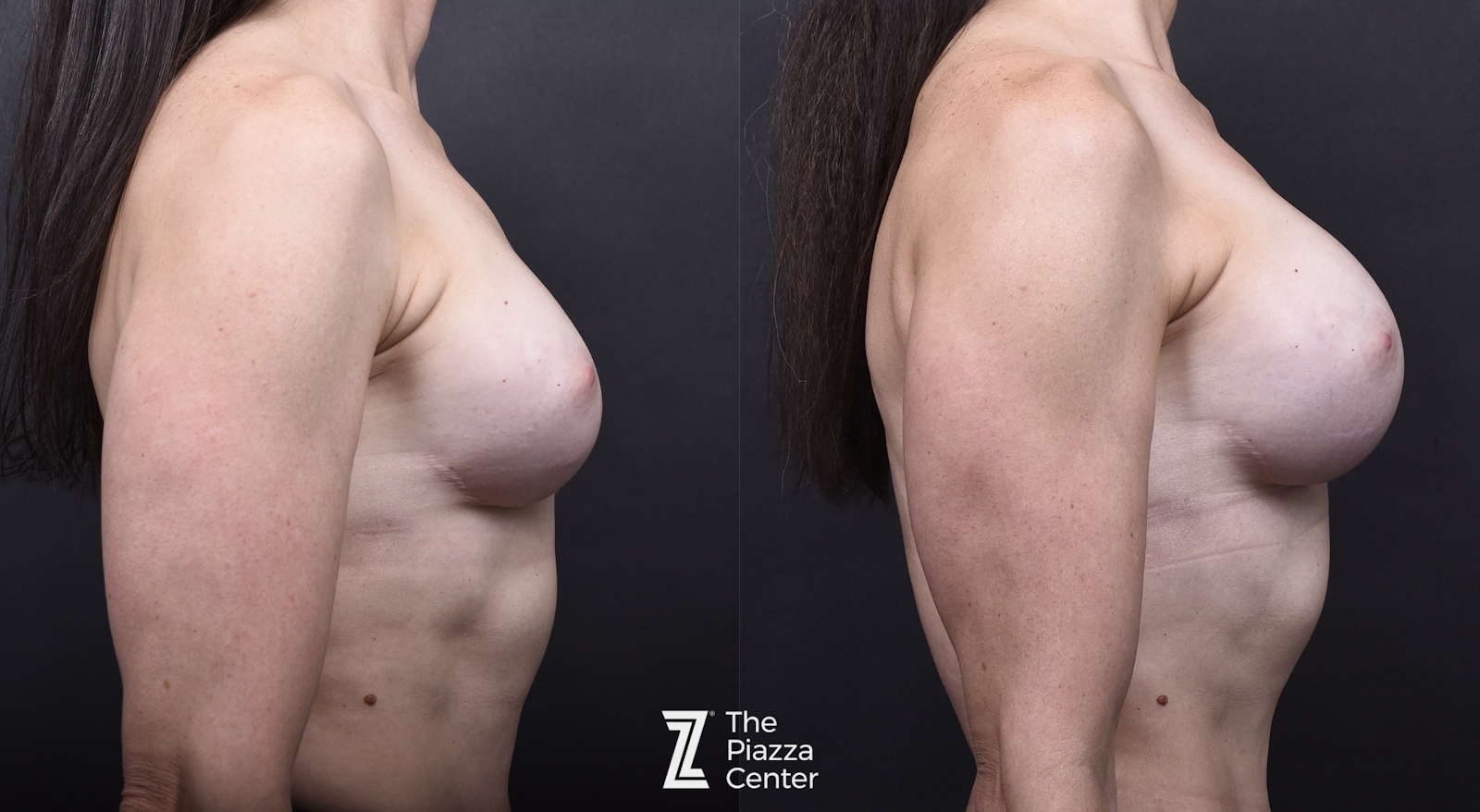 Austin Breast Augmentation Revision Before & After Gallery - Patient 252642 - Image 4 - The Piazza Center