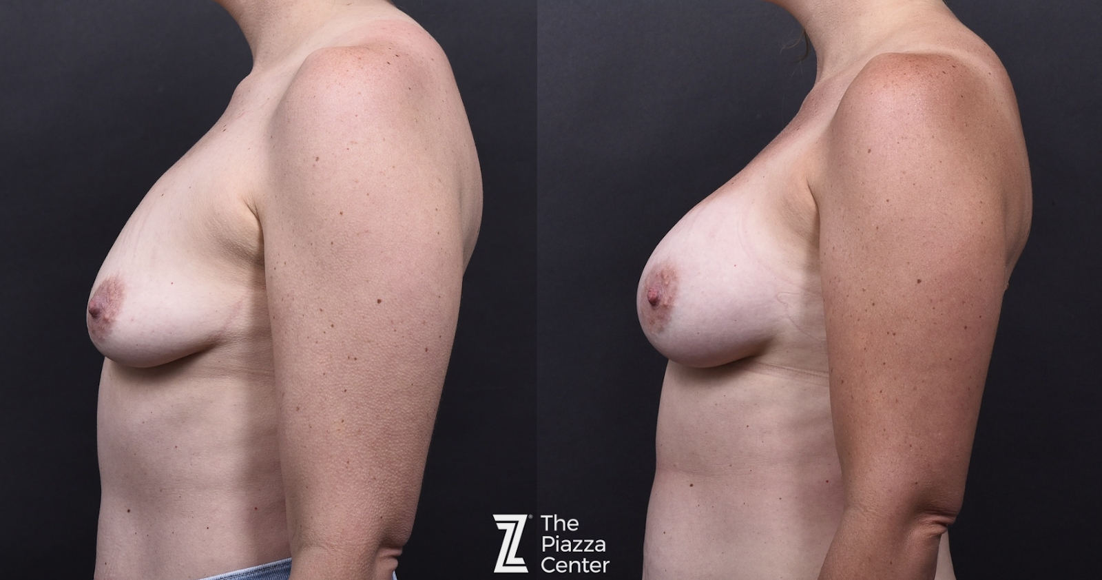 Austin Motiva Implants Before & After Gallery - Patient 261782 - Image 5 - The Piazza Center