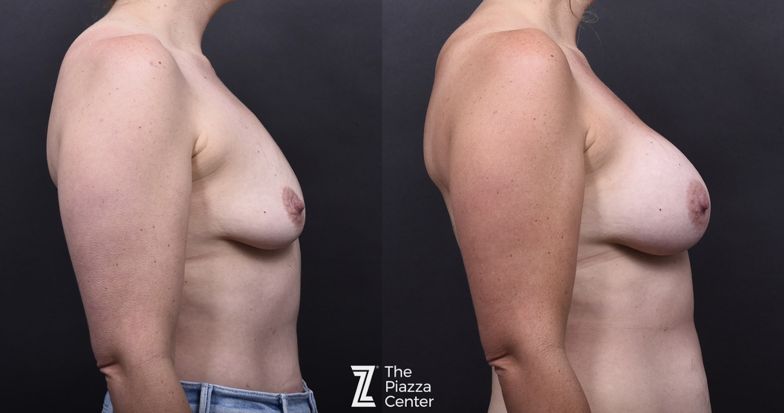 Austin Motiva Implants Before & After Gallery - Patient 261782 - Image 3 - The Piazza Center