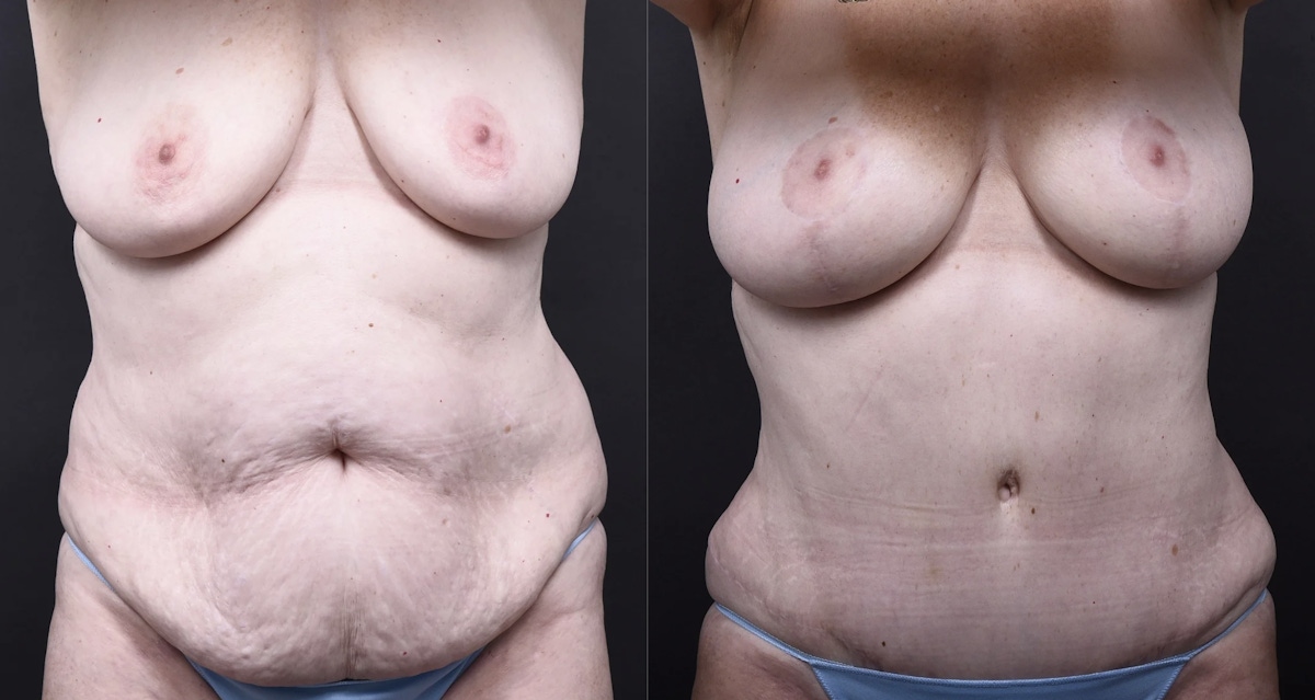 Austin Tummy Tuck Before & After Gallery - Patient 101511 - Image 1 - The Piazza Center