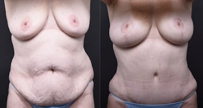 Austin Mommy Makeover Before & After Gallery - Patient 820235 - Image 1 - The Piazza Center