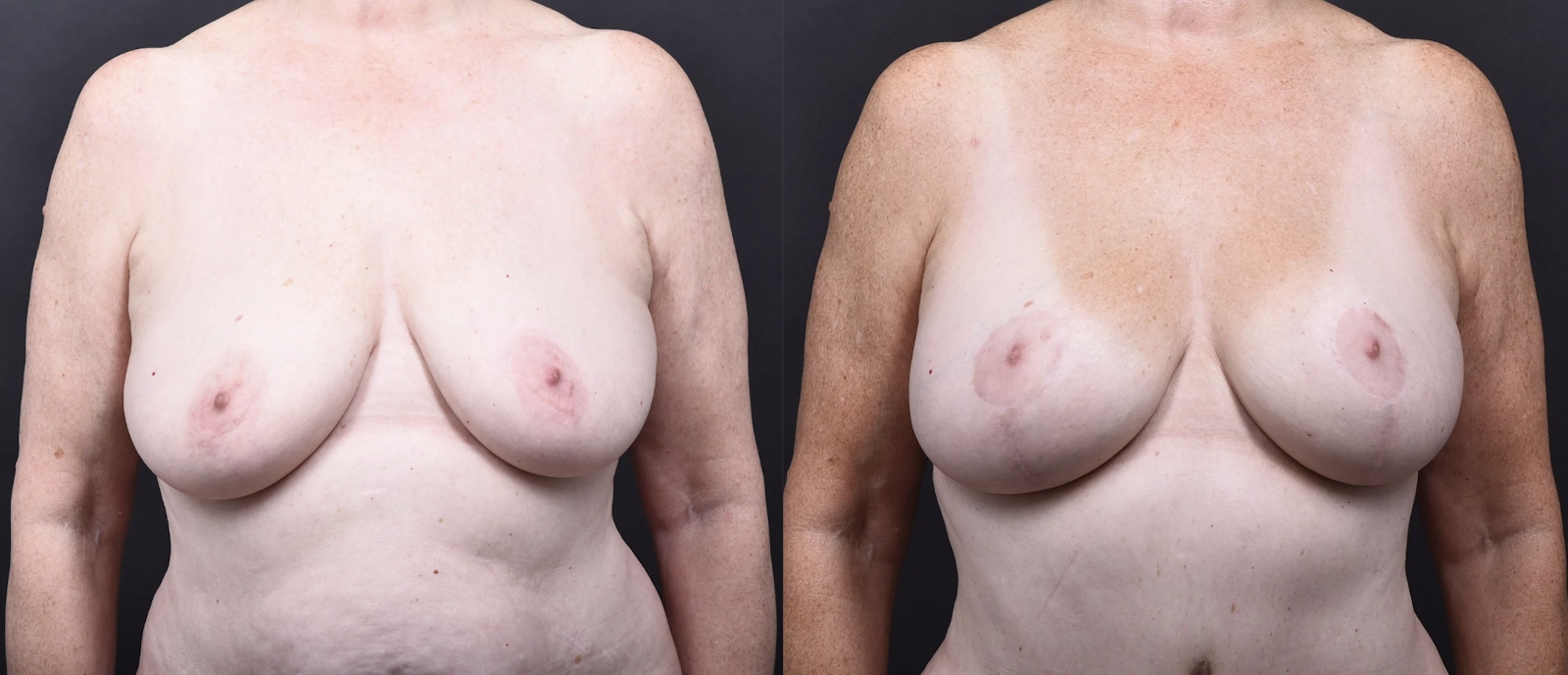 Austin Mommy Makeover Before & After Gallery - Patient 820235 - Image 4 - The Piazza Center