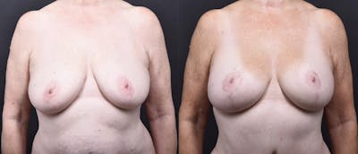 Austin Breast Augmentation With a Breast Lift Before & After Gallery - Patient 438571 - Image 1 - The Piazza Center