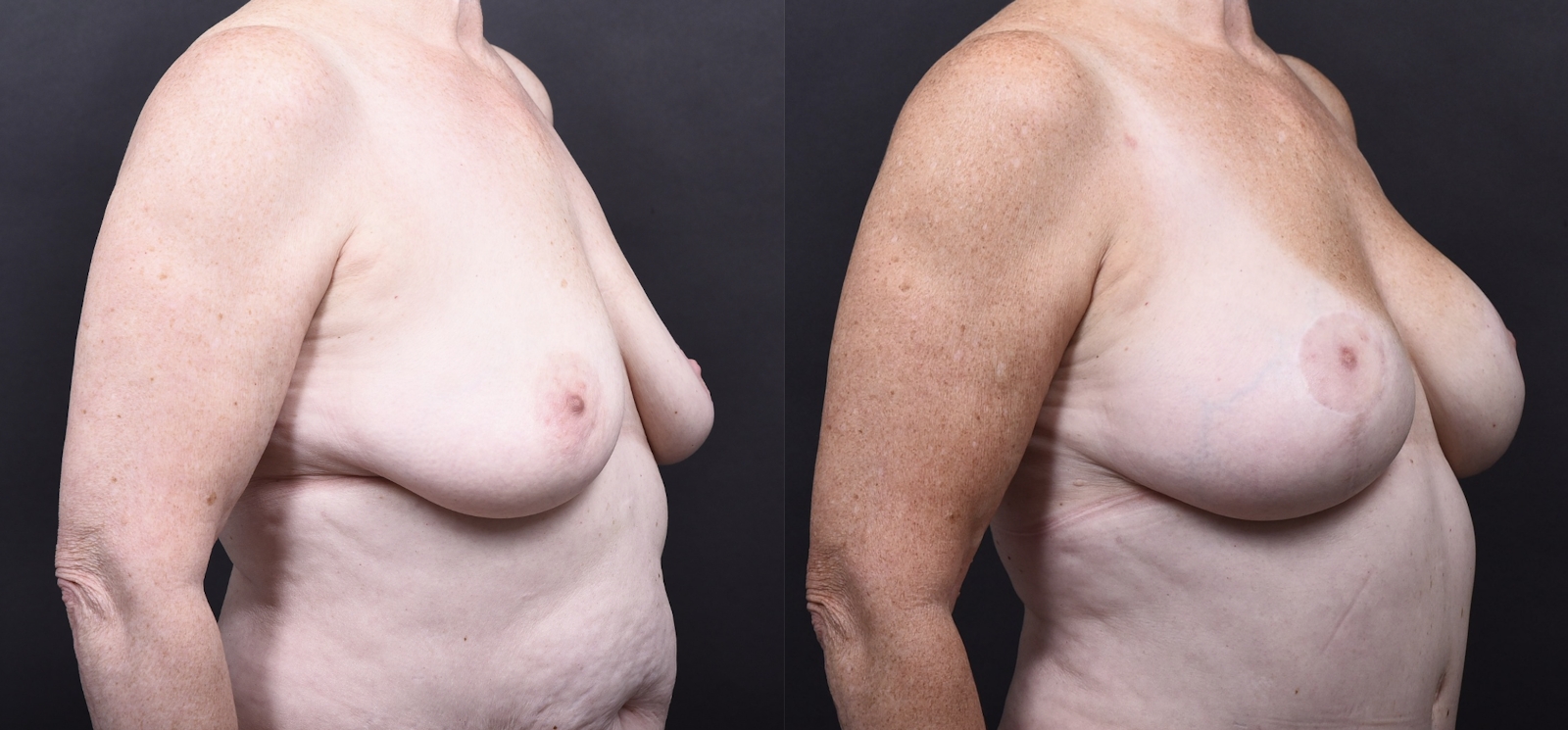 Austin Mommy Makeover Before & After Gallery - Patient 820235 - Image 5 - The Piazza Center