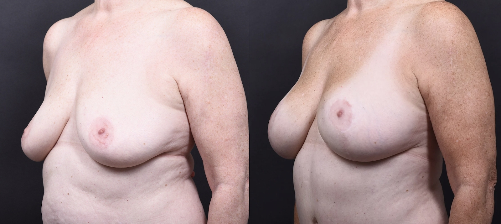 Austin Mommy Makeover Before & After Gallery - Patient 820235 - Image 7 - The Piazza Center