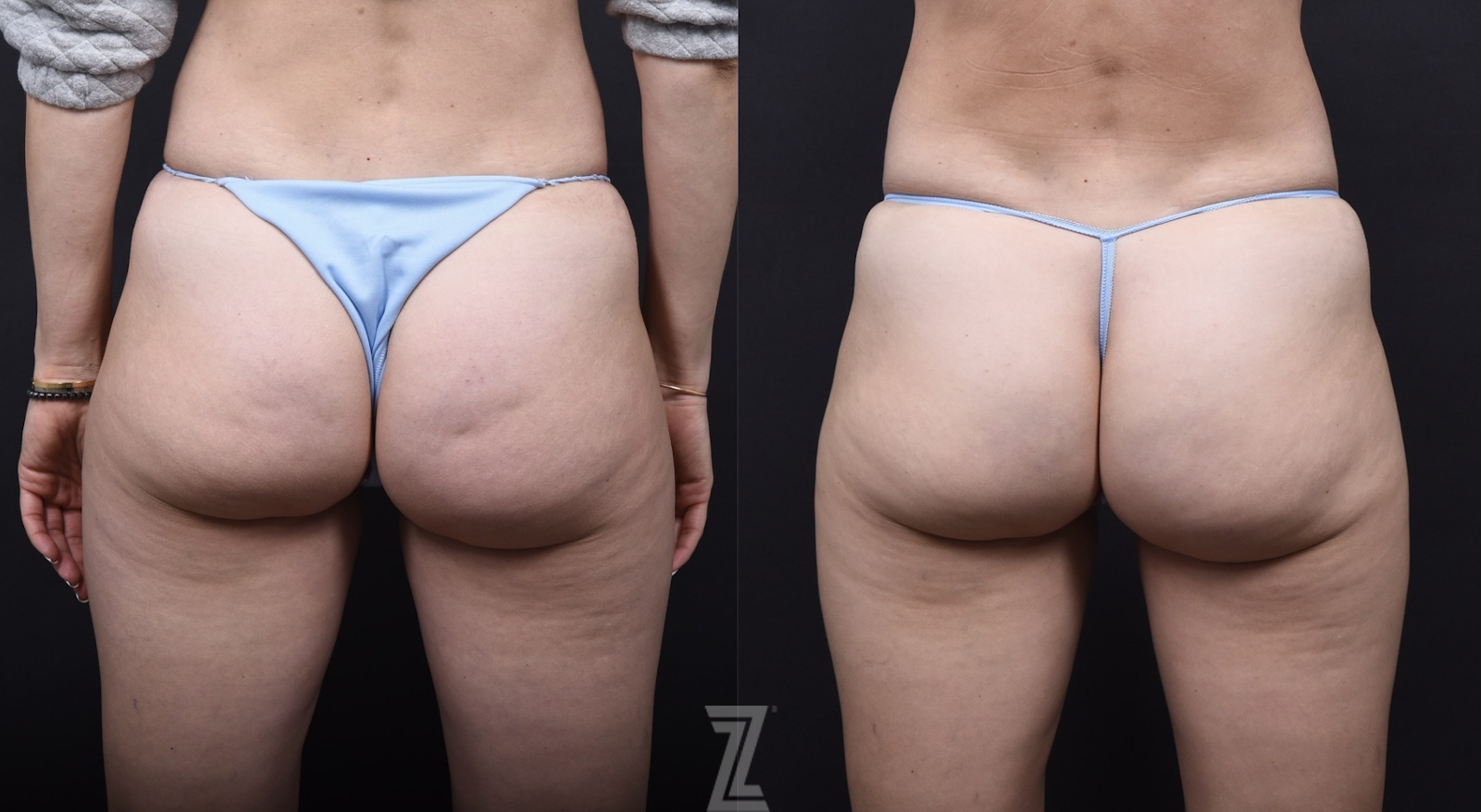 Austin Fat Transfer Before & After Gallery - Patient 306785 - Image 1 - The Piazza Center