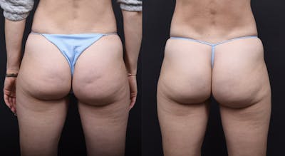 Austin Fat Transfer Before & After Gallery - Patient 306785 - Image 1 - The Piazza Center