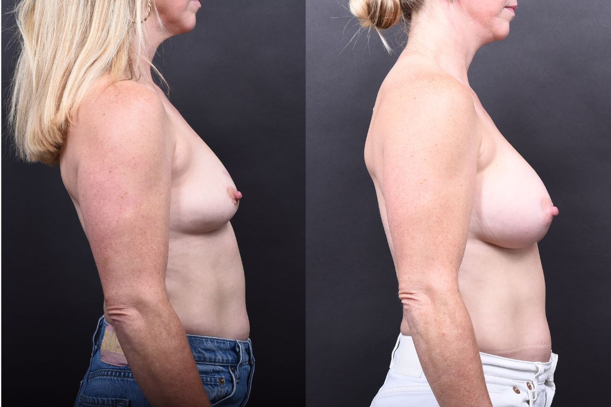 Austin Breast Augmentation Before & After Gallery - Patient 133398 - Image 3 - The Piazza Center