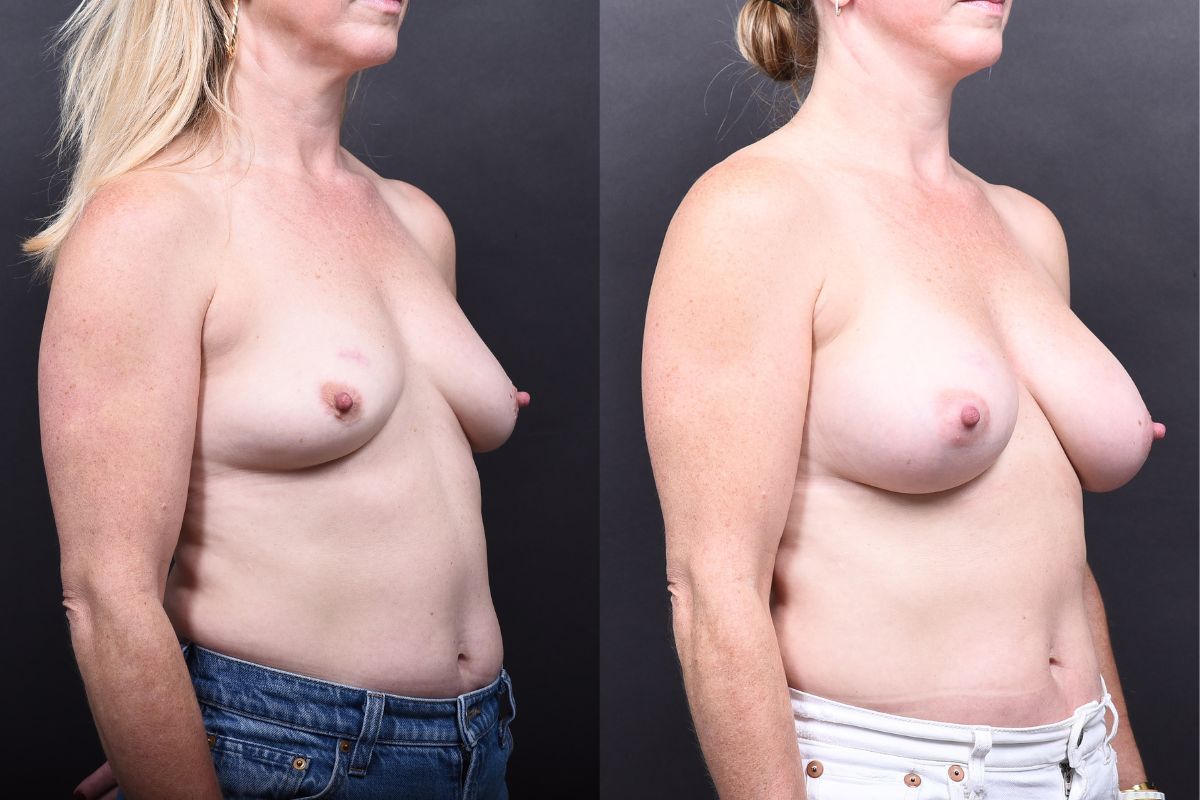 Austin Breast Augmentation Before & After Gallery - Patient 133398 - Image 2 - The Piazza Center
