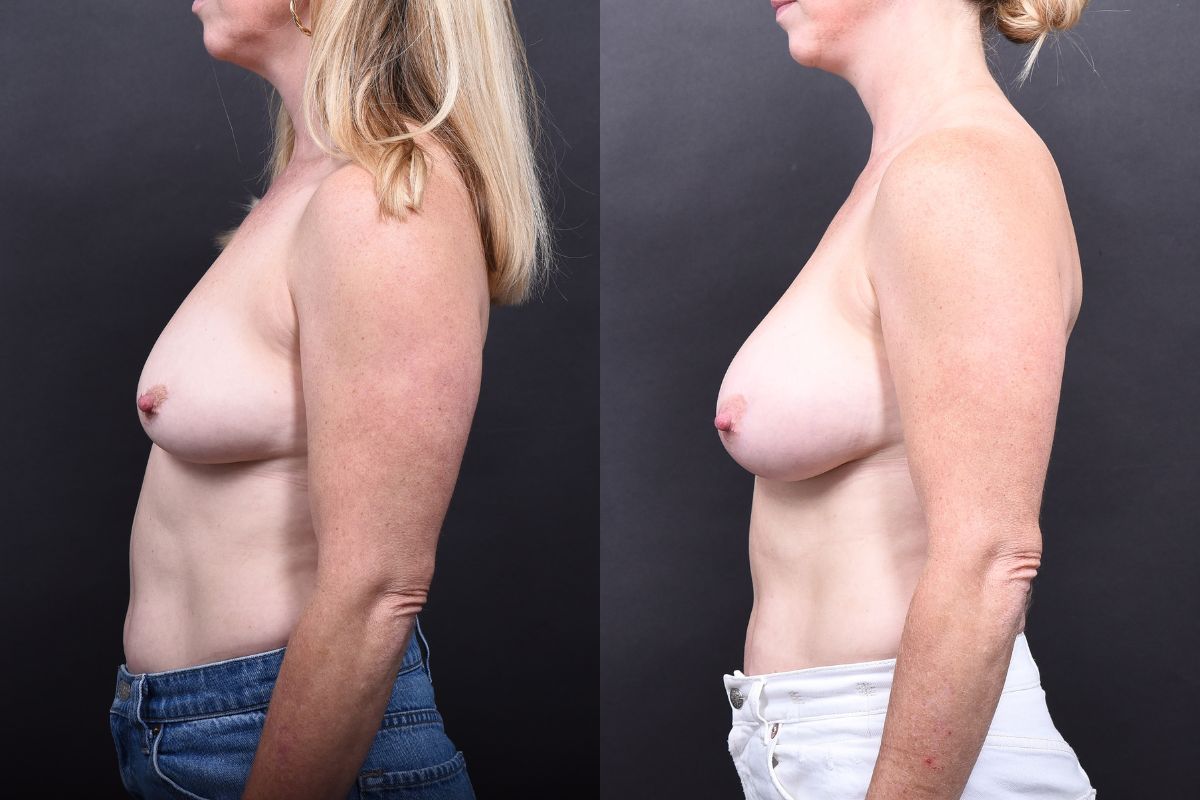 Austin Breast Augmentation Before & After Gallery - Patient 133398 - Image 5 - The Piazza Center