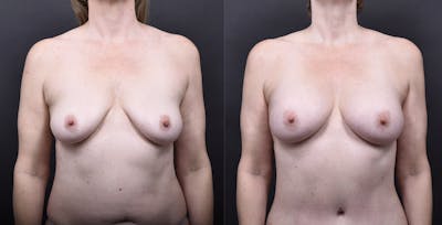 Austin Breast Augmentation Before & After Gallery - Patient 395673 - Image 1 - The Piazza Center