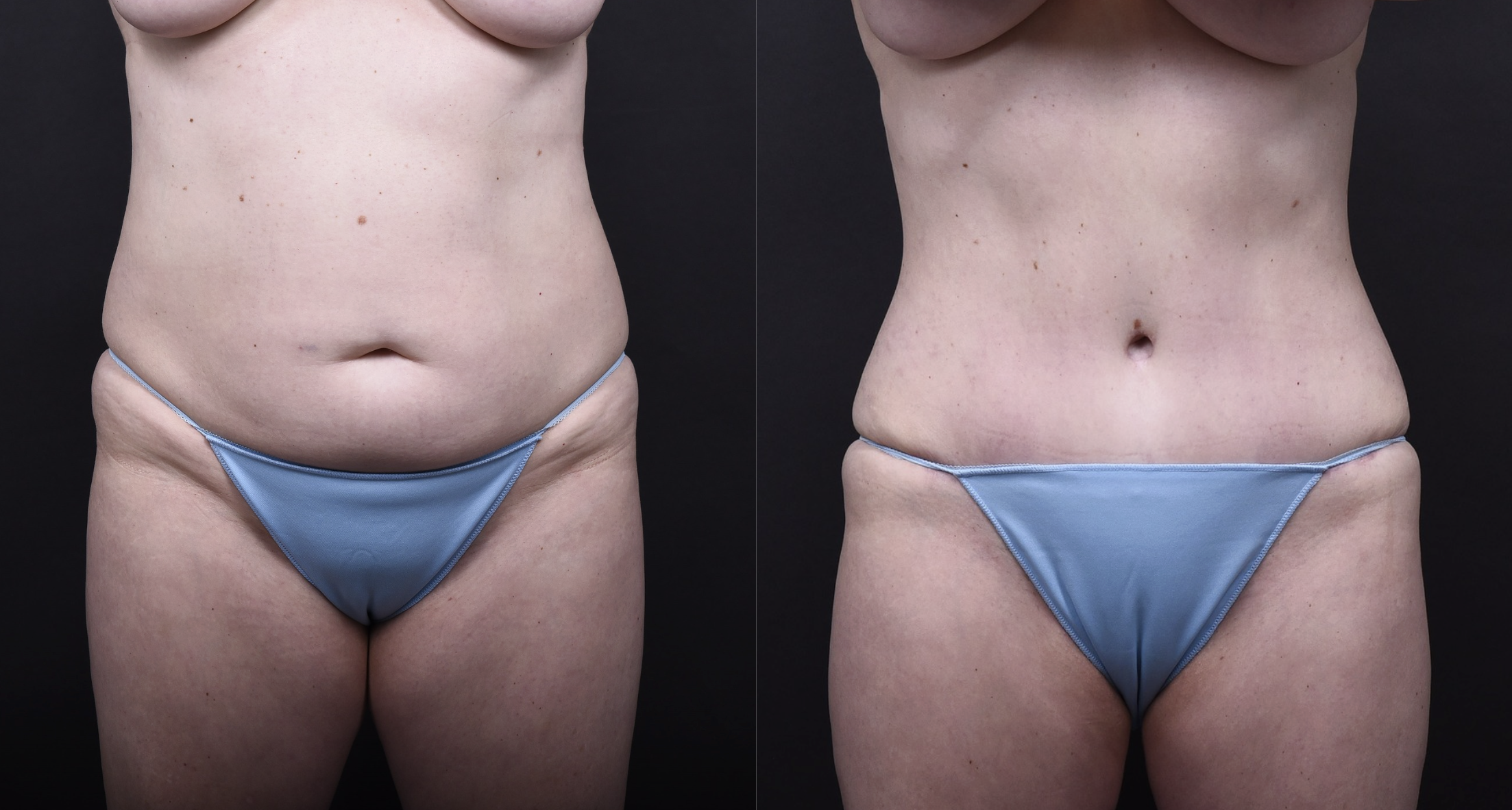 Austin Tummy Tuck Before & After Gallery - Patient 202557 - Image 1 - The Piazza Center