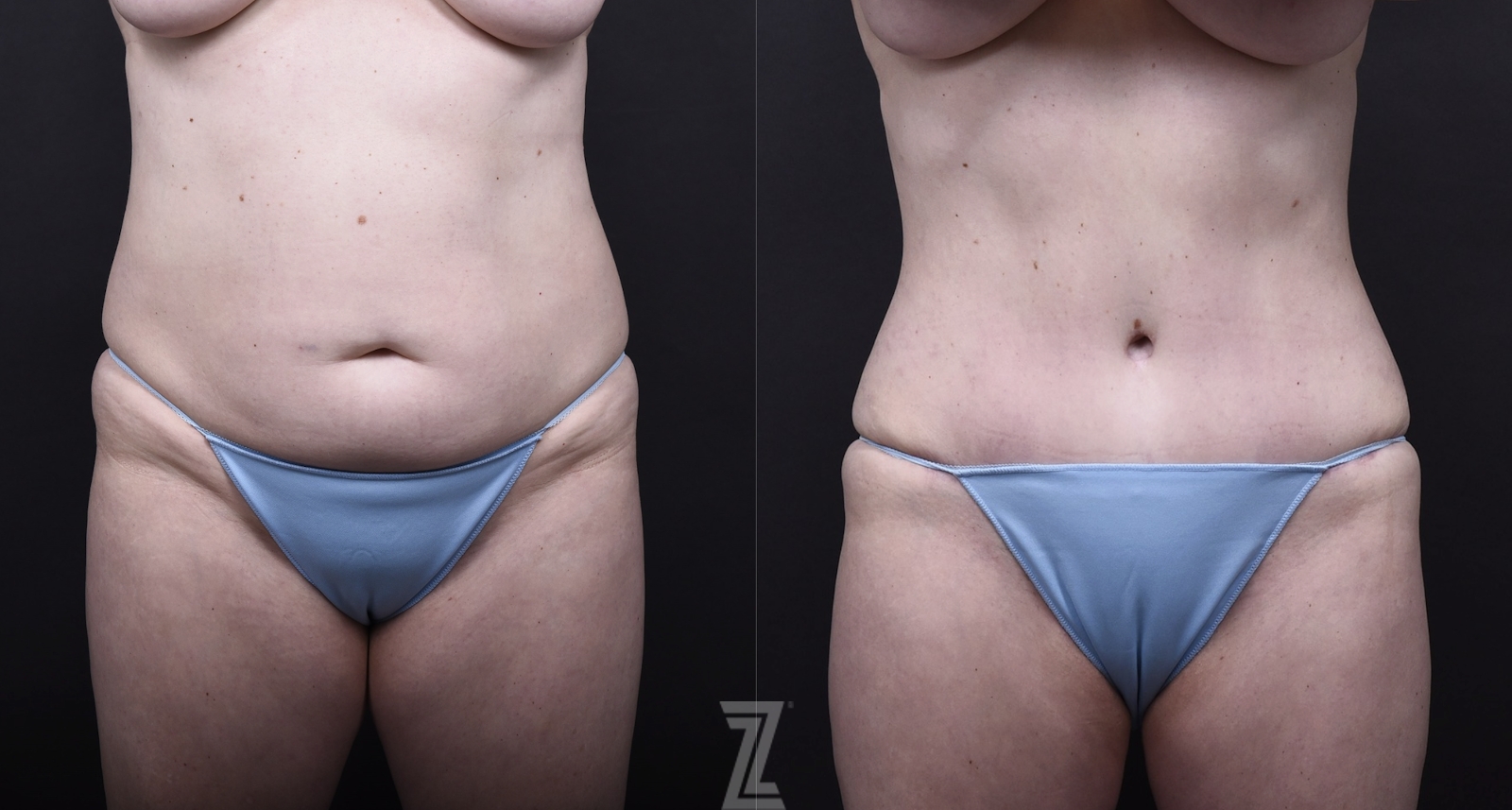 Austin Tummy Tuck Before & After Gallery - Patient 202557 - Image 1 - The Piazza Center
