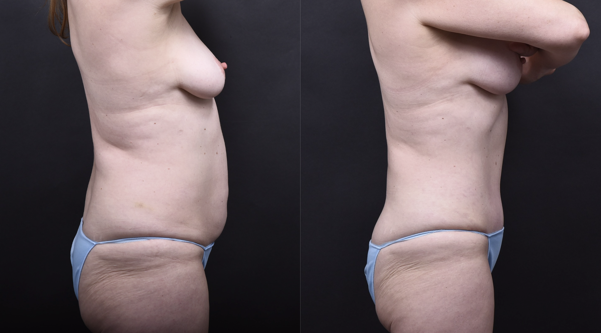 Austin Tummy Tuck Before & After Gallery - Patient 202557 - Image 2 - The Piazza Center