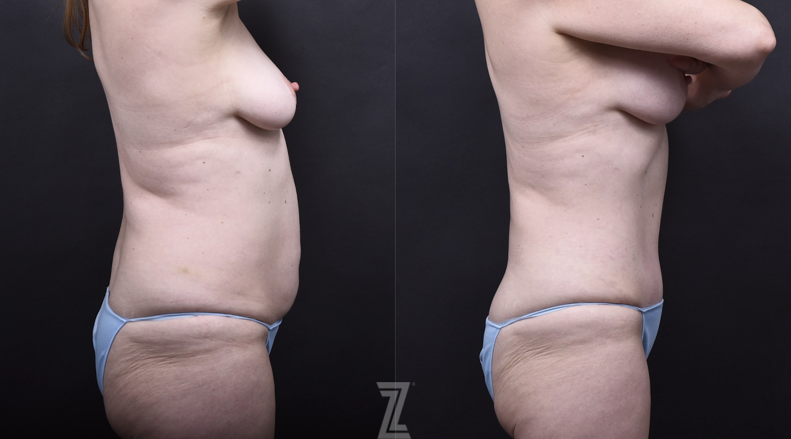 Austin Tummy Tuck Before & After Gallery - Patient 202557 - Image 2 - The Piazza Center