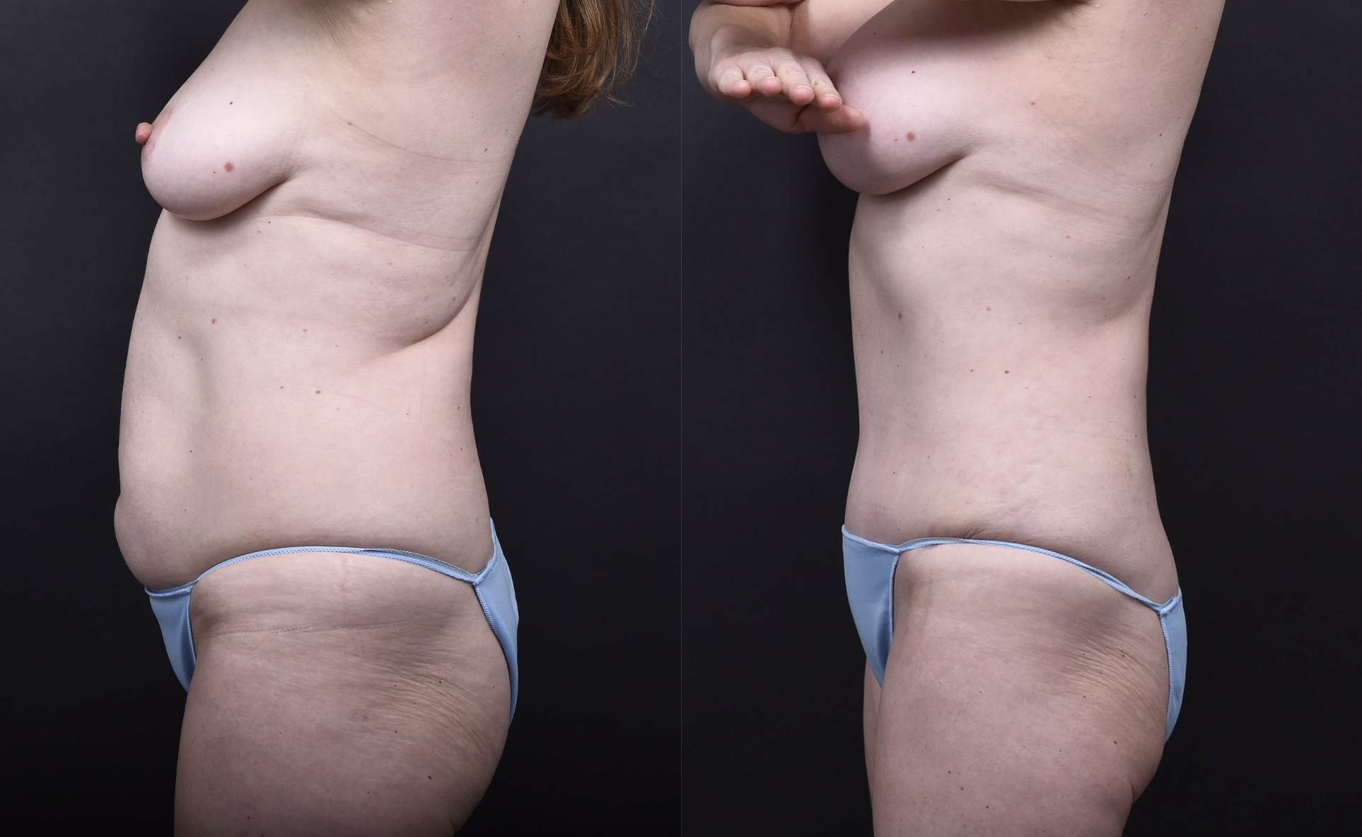 Austin Tummy Tuck Before & After Gallery - Patient 202557 - Image 4 - The Piazza Center