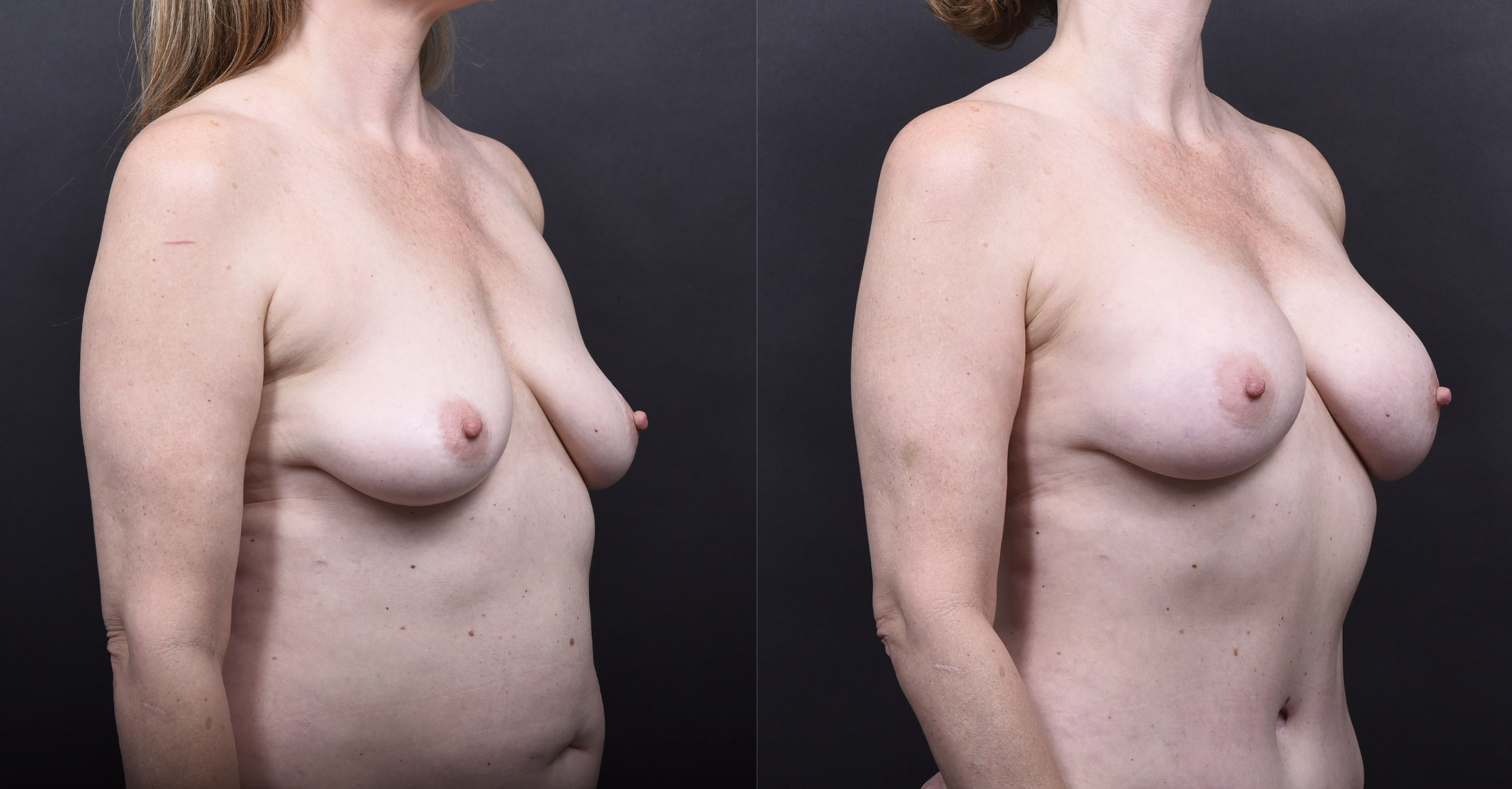 Austin Mommy Makeover Before & After Gallery - Patient 105405 - Image 8 - The Piazza Center