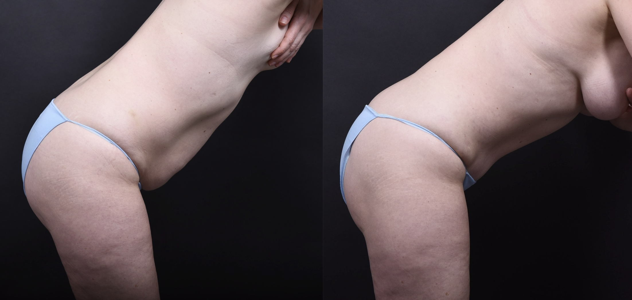 Austin Tummy Tuck Before & After Gallery - Patient 202557 - Image 3 - The Piazza Center