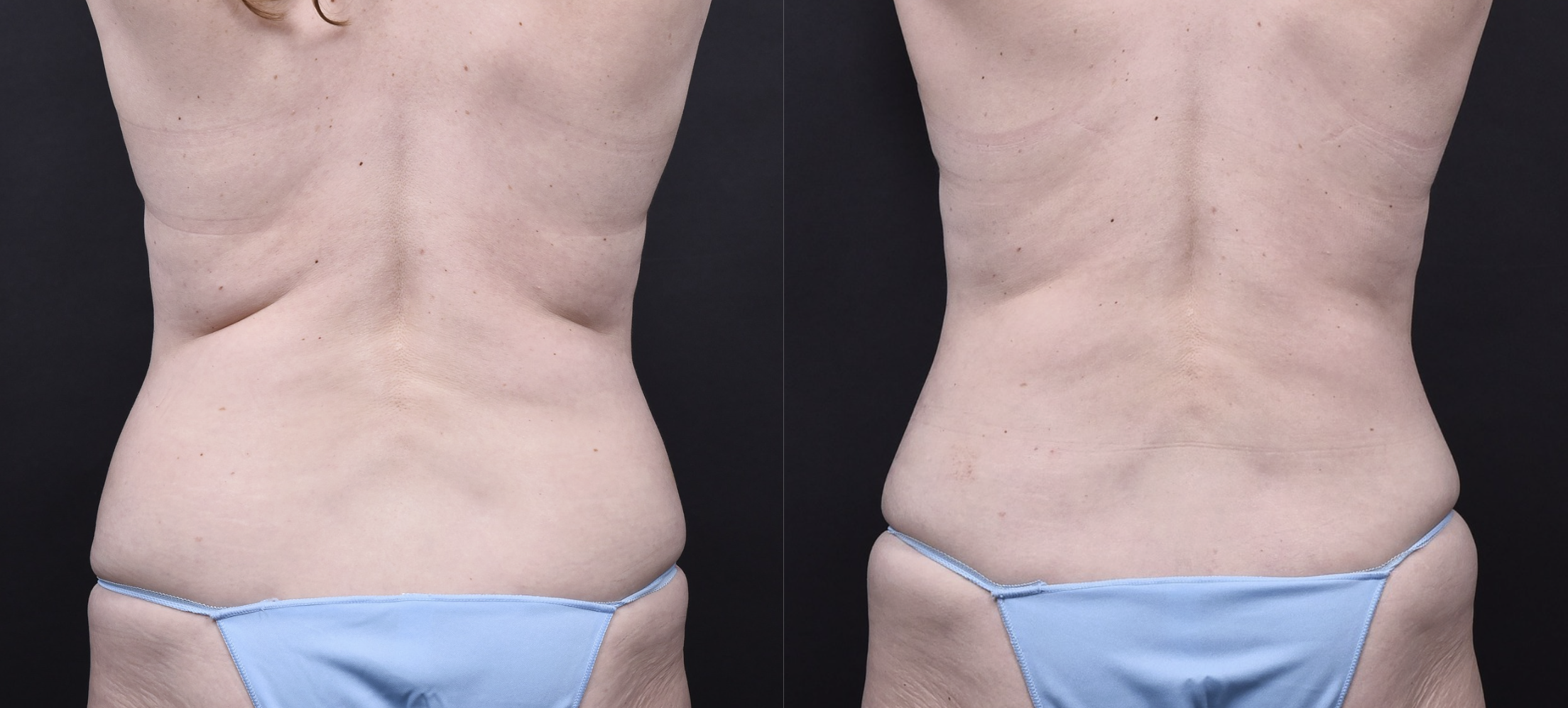 Austin Tummy Tuck Before & After Gallery - Patient 202557 - Image 6 - The Piazza Center
