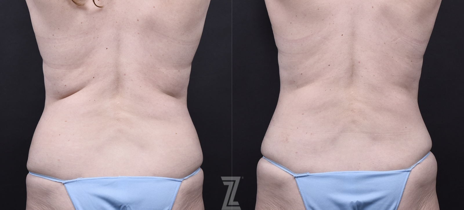 Austin Tummy Tuck Before & After Gallery - Patient 202557 - Image 6 - The Piazza Center