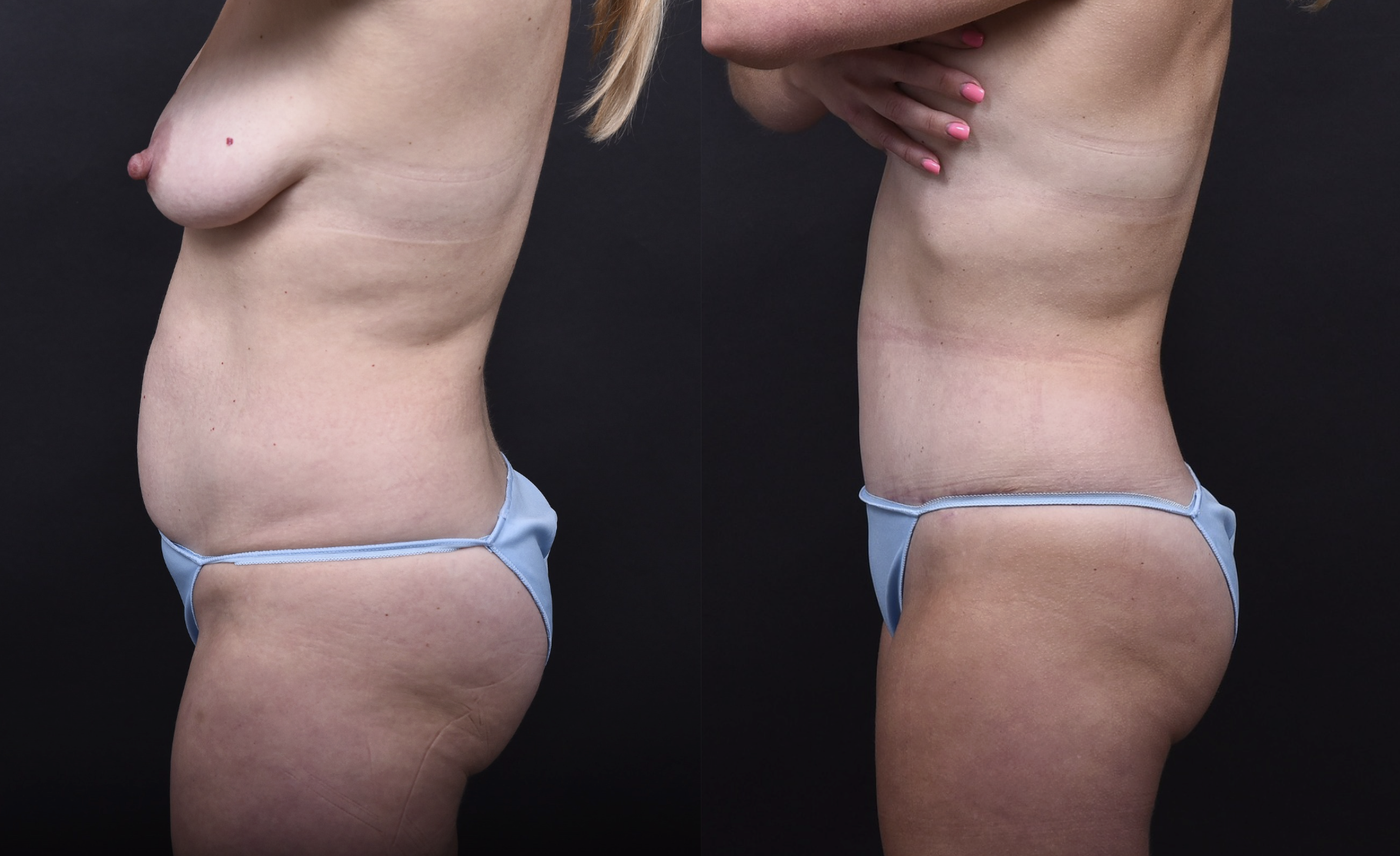 Austin Tummy Tuck Before & After Gallery - Patient 169865 - Image 4 - The Piazza Center