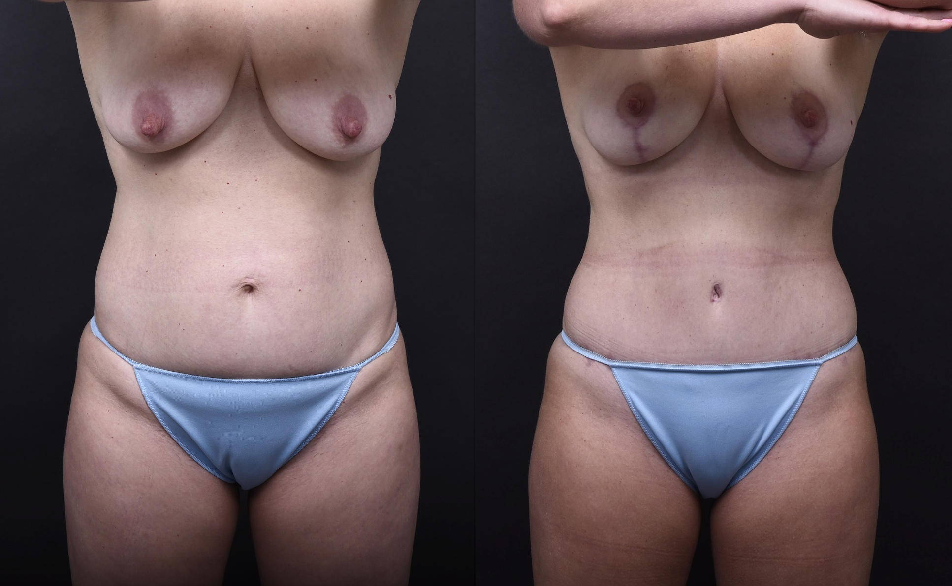 Austin Tummy Tuck Before & After Gallery - Patient 169865 - Image 1 - The Piazza Center