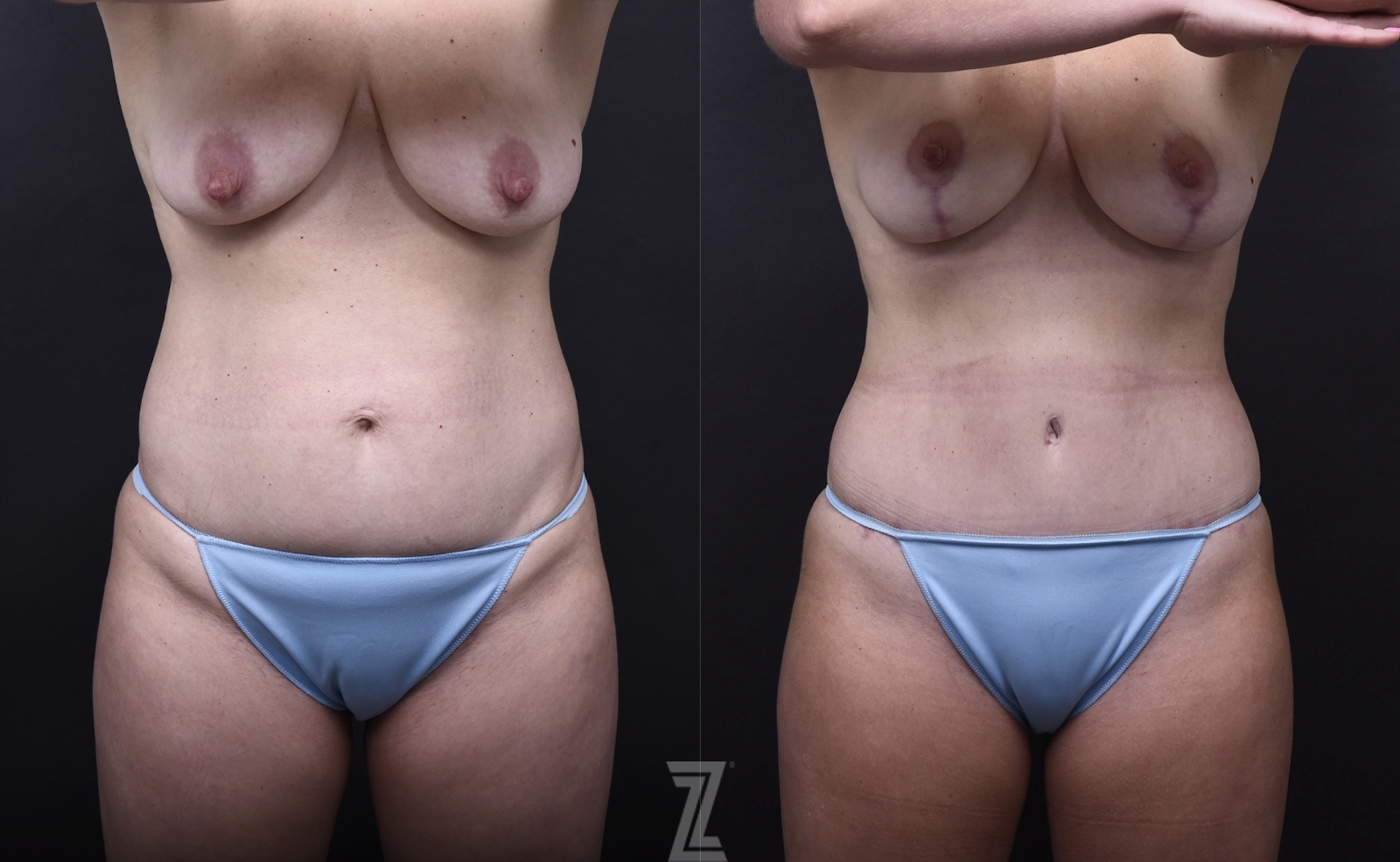 Austin Mommy Makeover Before & After Gallery - Patient 851555 - Image 1 - The Piazza Center