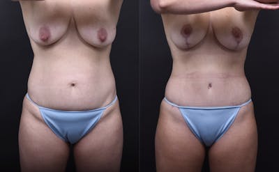 Austin Mommy Makeover Before & After Gallery - Patient 851555 - Image 1 - The Piazza Center