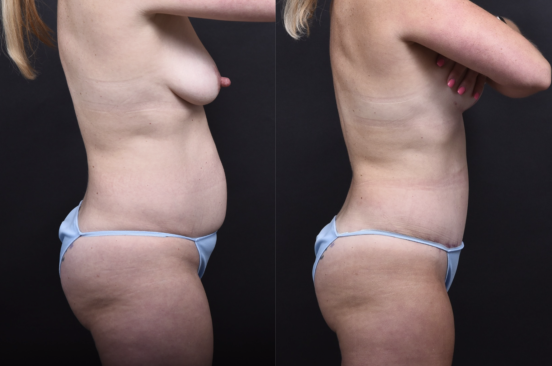 Austin Tummy Tuck Before & After Gallery - Patient 169865 - Image 2 - The Piazza Center