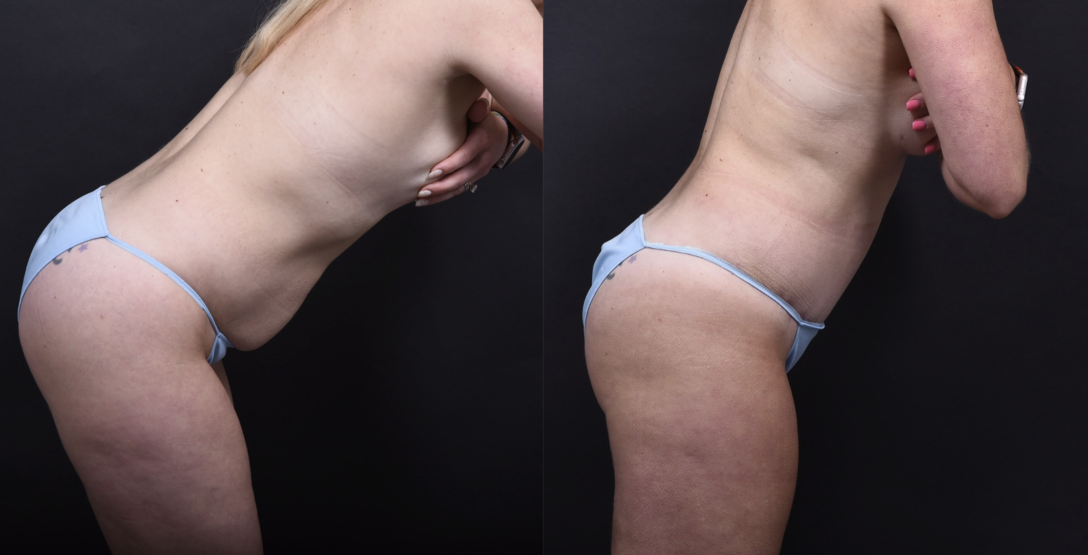 Austin Tummy Tuck Before & After Gallery - Patient 169865 - Image 3 - The Piazza Center