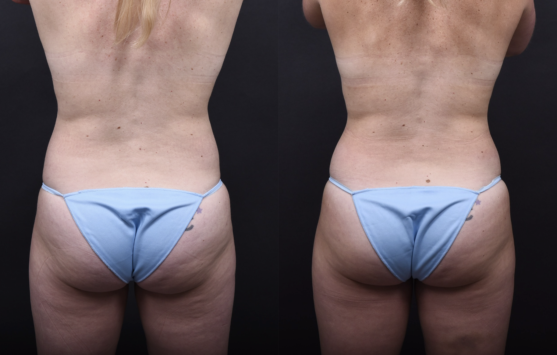 Austin Tummy Tuck Before & After Gallery - Patient 169865 - Image 6 - The Piazza Center