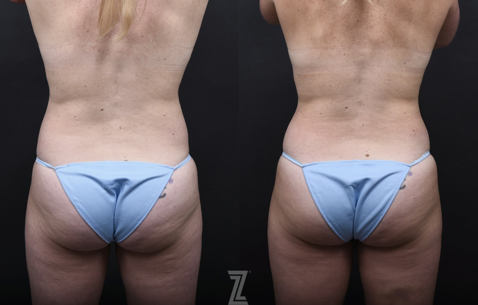 Austin Mommy Makeover Before & After Gallery - Patient 851555 - Image 6 - The Piazza Center