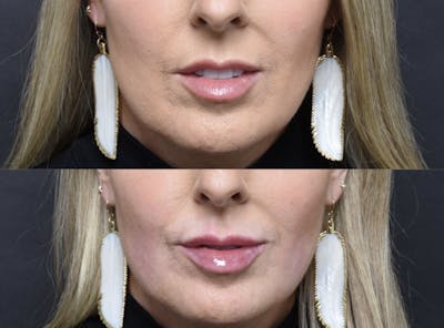 Austin Injectable Fillers Before & After Gallery - Patient 411830 - Image 1 - The Piazza Center