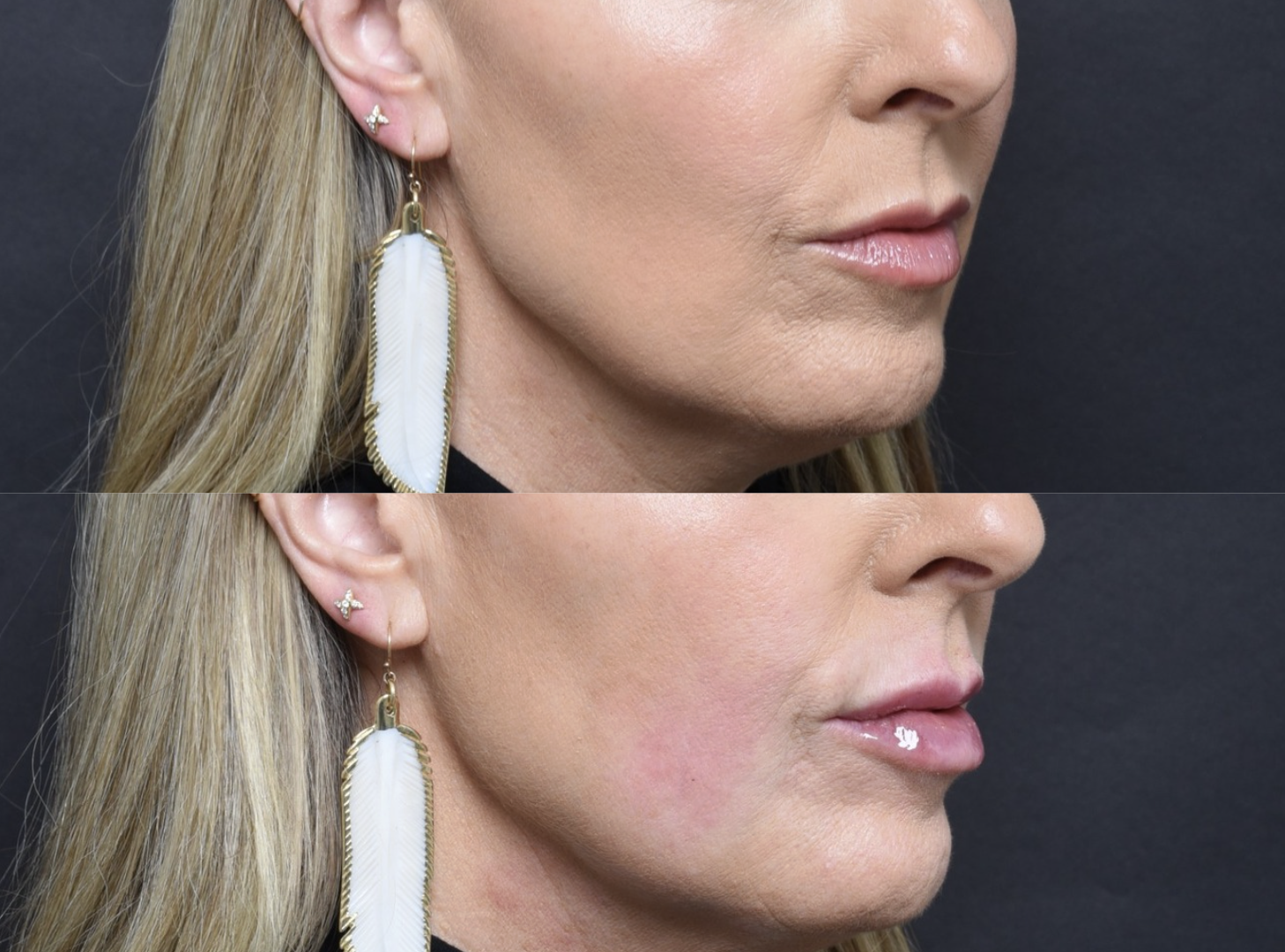 Austin Injectable Fillers Before & After Gallery - Patient 411830 - Image 2 - The Piazza Center