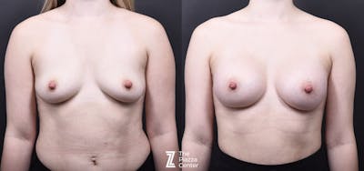 Austin Breast Augmentation Before & After Gallery - Patient 369861 - Image 1 - The Piazza Center