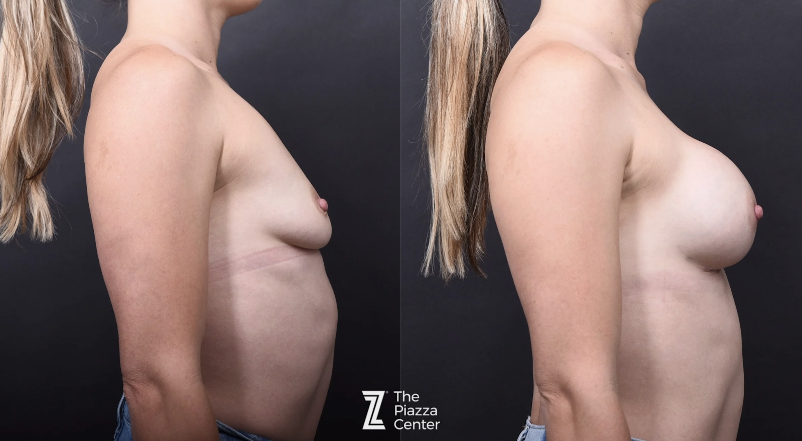 Austin Breast Augmentation Before & After Gallery - Patient 193073 - Image 3 - The Piazza Center