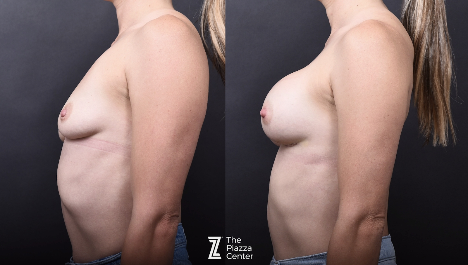 Austin Breast Augmentation Before & After Gallery - Patient 193073 - Image 4 - The Piazza Center