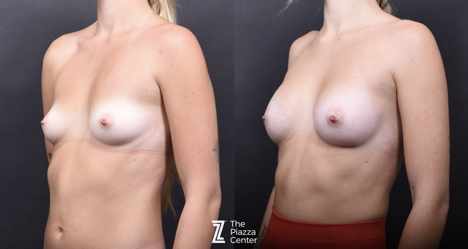 Austin Motiva Implants Before & After Gallery - Patient 168814 - Image 4 - The Piazza Center