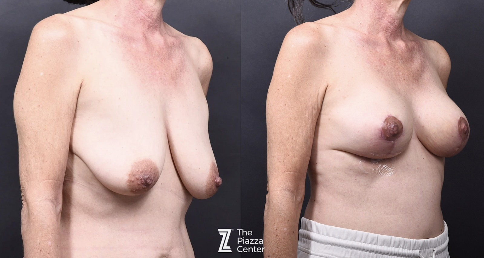 Austin Motiva Implants Before & After Gallery - Patient 883817 - Image 2 - The Piazza Center