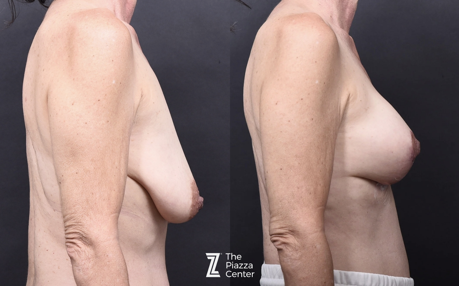 Austin Motiva Implants Before & After Gallery - Patient 883817 - Image 3 - The Piazza Center